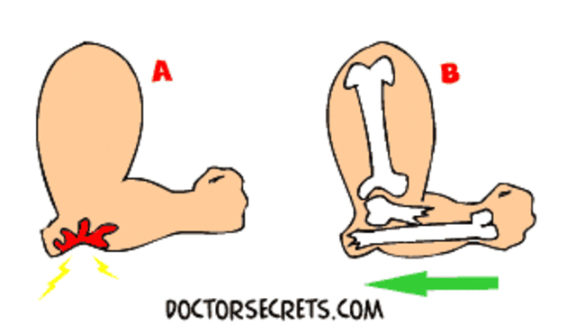 the fist i broke bone