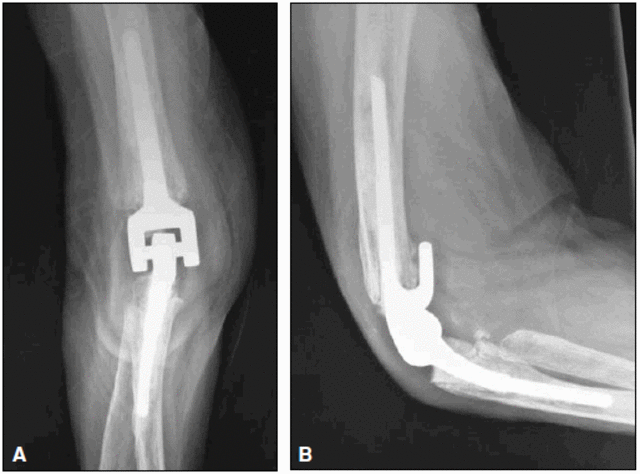 Polimetilmetacrilato
