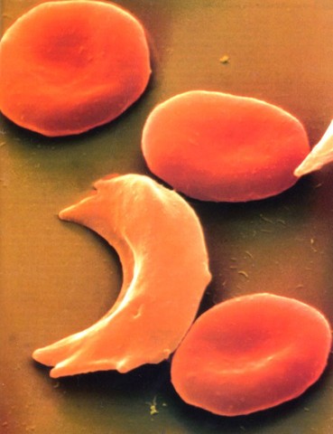 Nixon signs the Sickle Cell Anemia Control Act