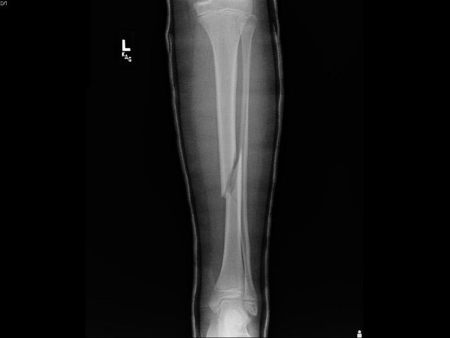 Je me suis cassé la jambe dans un accident de ski.