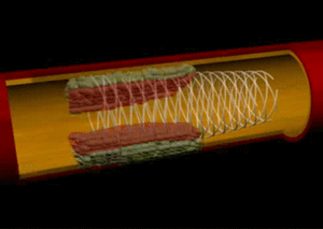 Stent biodegradable de magnesio