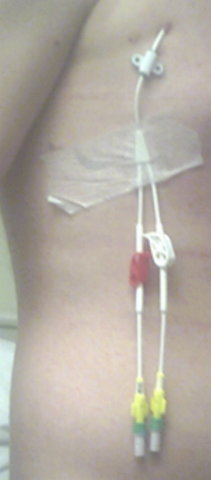 Catéter de silicona