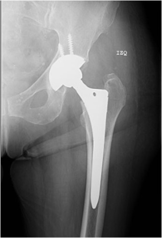 Biomaterial - Aleacion Cobalto-Cromo