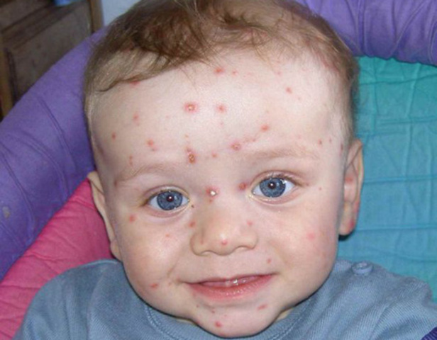 measles vaccine