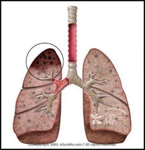 tuberculosis vaccine