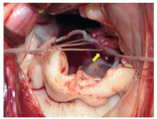 Politetrafluoroetilena
