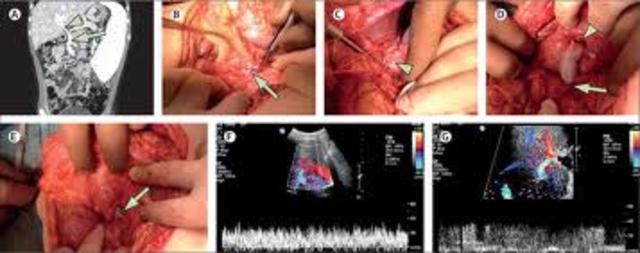 The world's first stem-cell assisted vein transplant is undertaken by Swedish doctors on a 10 year old gir
