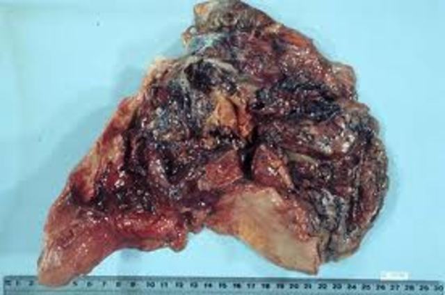 Amianto o asbesto. Sustancia tóxica.