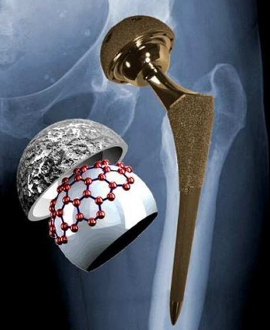 Prótesis de cadera