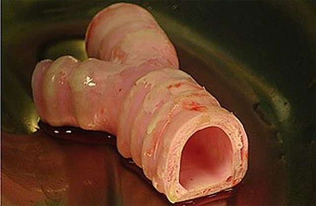 Scafold o andamiaje sintético: biomaterial.