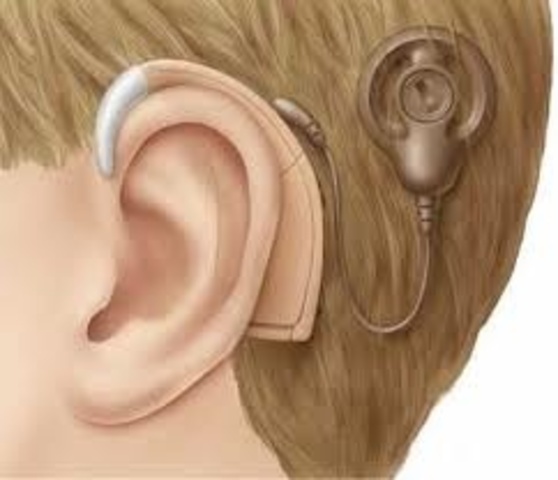 Cochlear Implants Approved