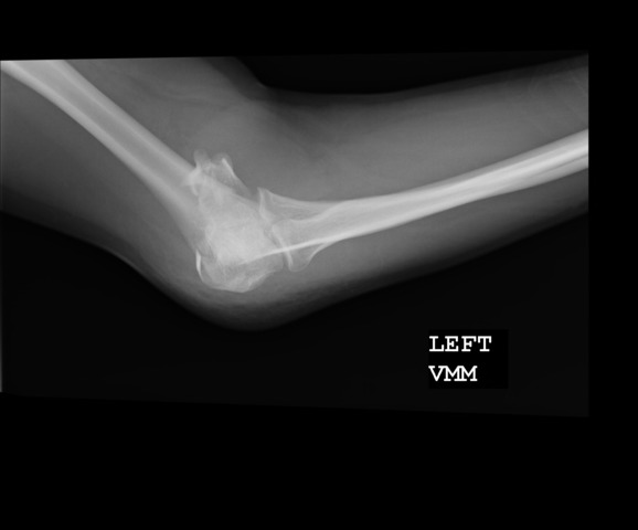 Broken Arm