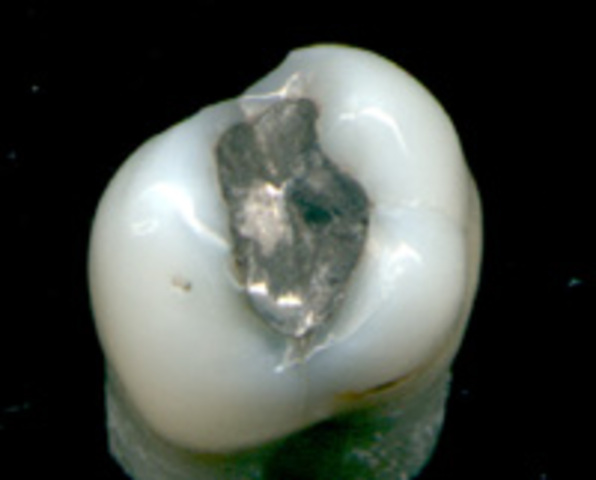 AMALGAMA PLATA (TÓXICO)