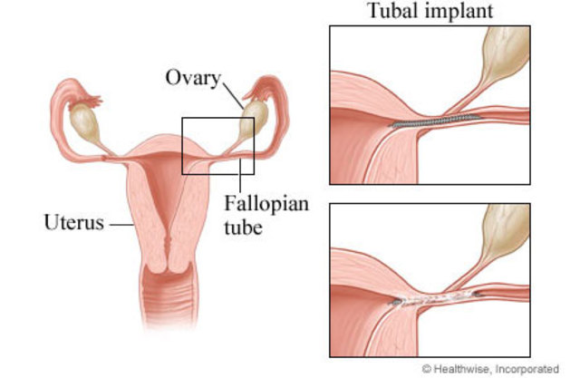 Zygote Travels through the Fallopean Tube
