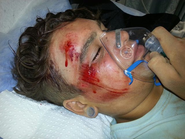 hospitalized from BMX