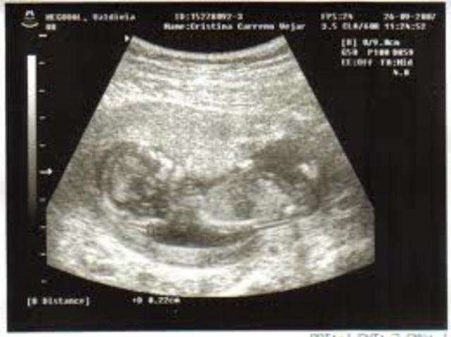 Primera ecografia