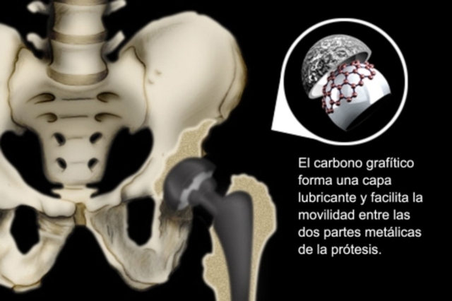 Protesis de cadera - Carbono grafítico