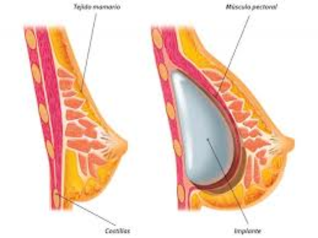 IMPLANTES MAMARIIOS (Biomaterial)