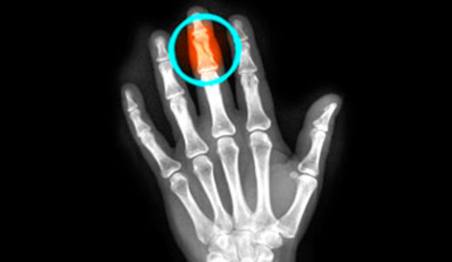 Broken Finger