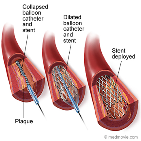 Stents