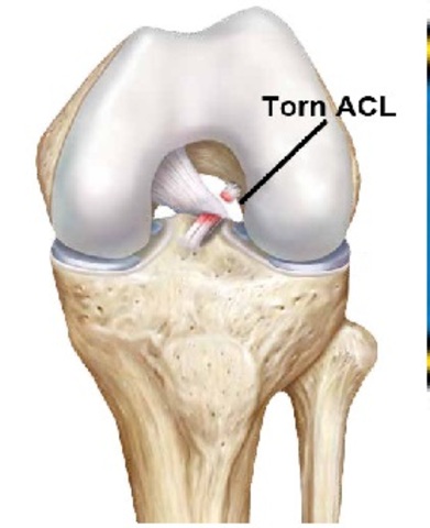 Torn ACL para o primeiro tempo, joelho quebrado.