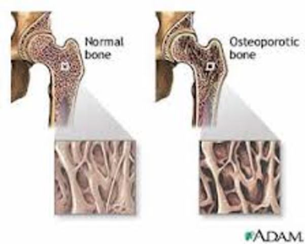 CERÁMICAS DE FOSFATO DE CALCIO