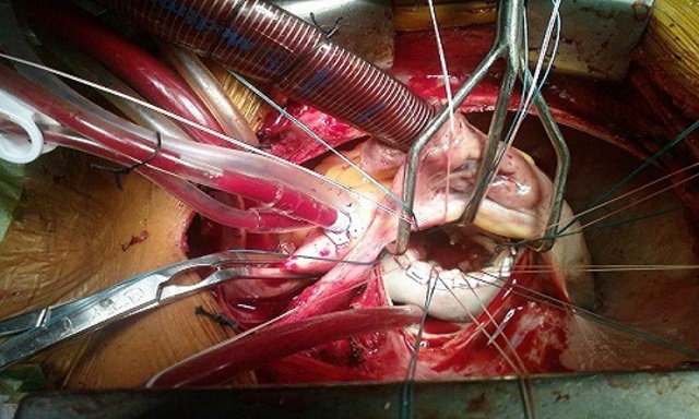 First open heart surgery
