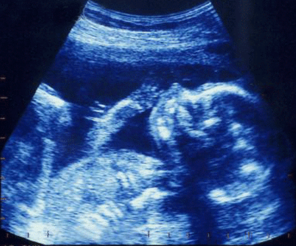 LA 3 ECOGRAFIA DE MI BEBE