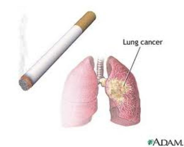 Lung Cancer