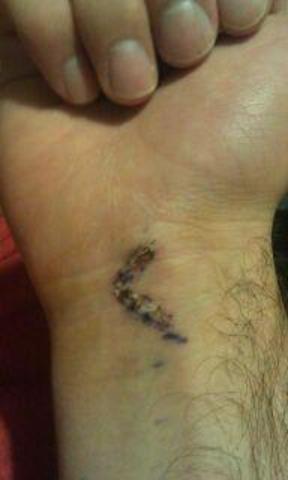 Tommy John Surgery