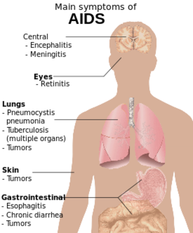 AID's Disease Spreads