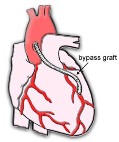 Cardiac Bypass