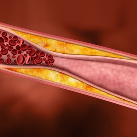 Coronary Artery Disease Risk Factors