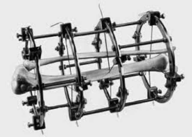 Ilizarov Apparatus