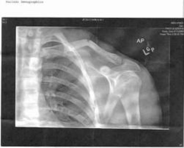 broke collarbone