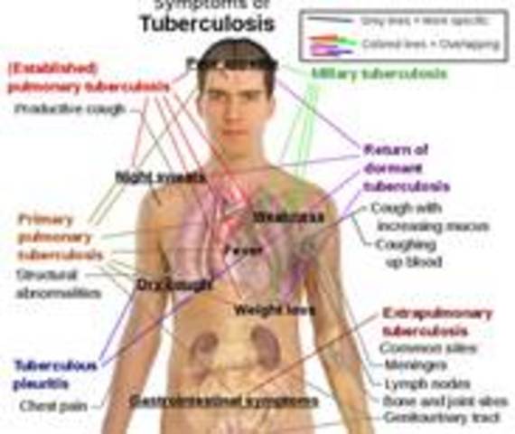 John is diagnosed with TB.