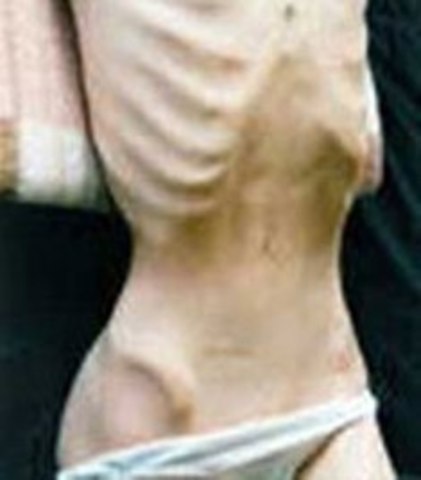 PRIMERA DESCRIPCIÓN DE ANOREXIA:SIGLO XVII