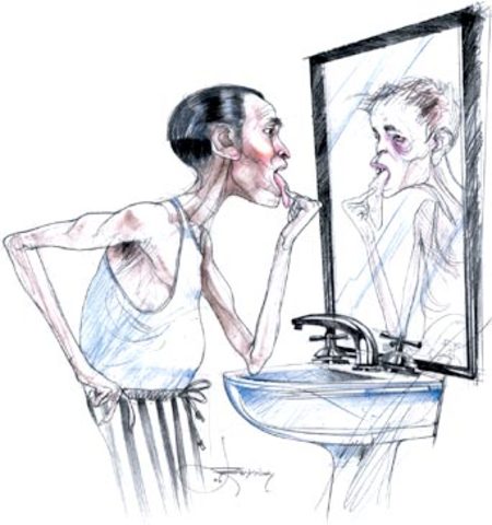 ANOREXIA=DELIRIO HIPOCONDRIACO