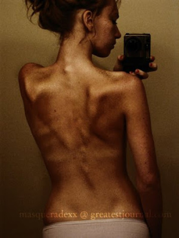 ANOREXIA =APESTA NERVIOSA