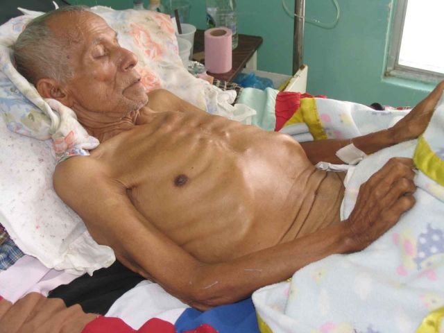 CAQUEXIA HIPOFISARIA