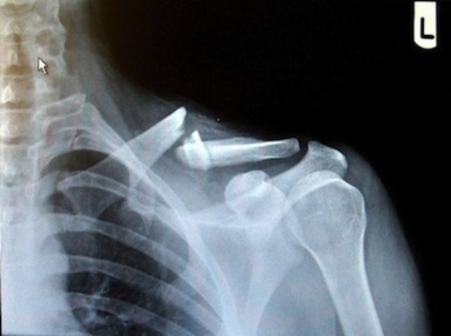broke colar bone