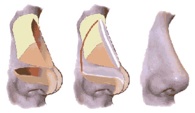 Biomaterial - Rinoplastia, uso de siliconas. Biomaterial
