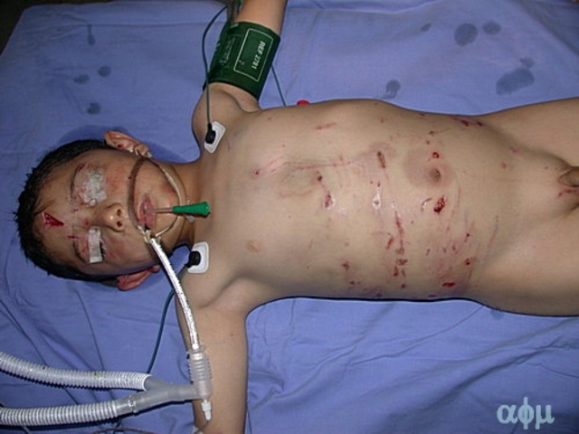 Maltratan a bebé con mordeduras