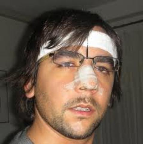 cirugia de nariz "turbinoplastia y septoplastia