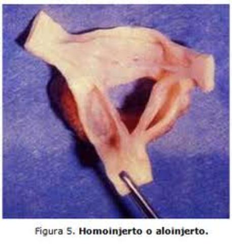 Primer transplante de válvula cardiaca.