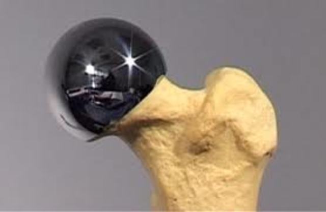 Primer transplante de cadera