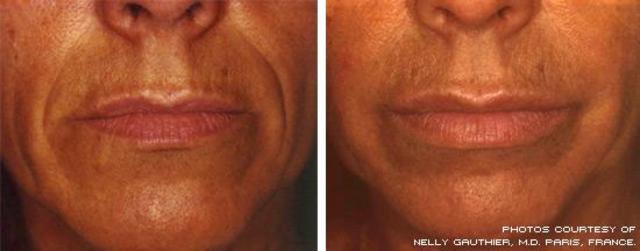 BIOMATERIAL - Artecoll