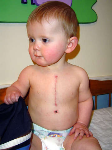 Second heart surgery