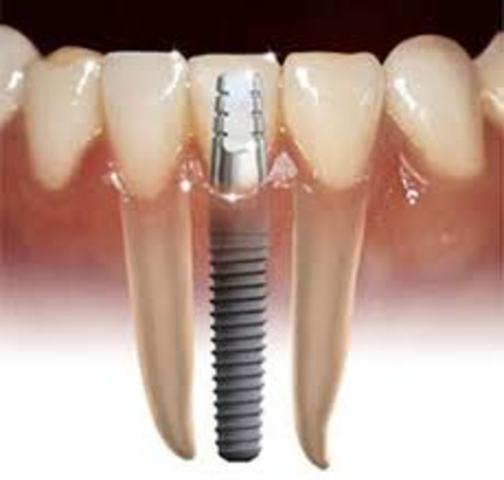 Implantes dentales - Biomateriales