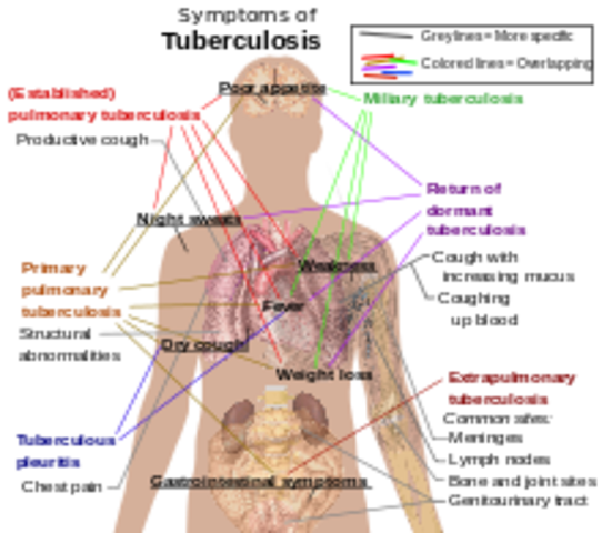 Jack is diagnosed with TB.